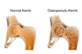 Kemik Erimesi Nasıl Önlenebilir?