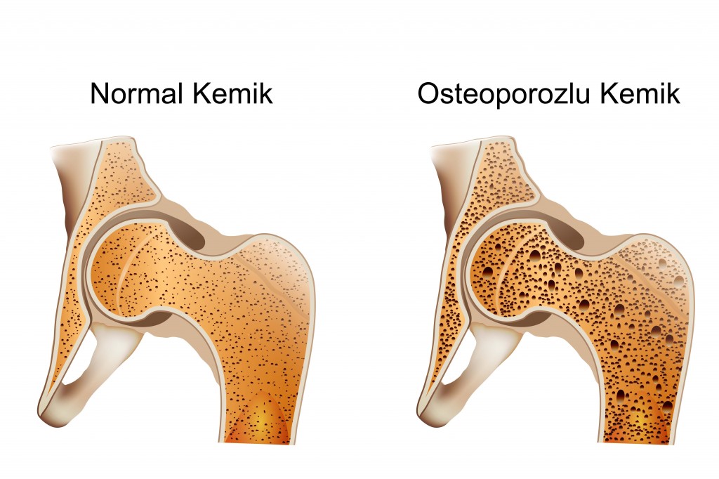 Kemik Erimesi Nasıl Önlenebilir? Kemik Erimesi Nasıl Önlenebilir?
