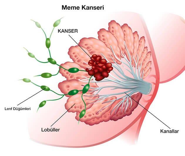 Meme Kanseri Hakkında Bilmediğiniz 5 Şaşırtıcı Gerçek Meme Kanseri Hakkında Bilmediğiniz 5 Şaşırtıcı Gerçek