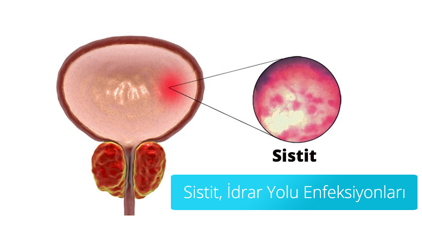 Kadınlarda İdrar Yolu Enfeksiyonu Belirtileri Nelerdir? 3 İdrar Yolu Enfeksiyonuna Ne İyi Gelir
