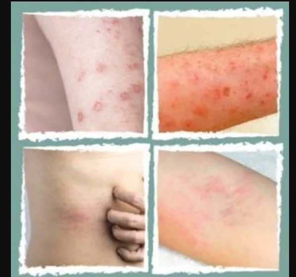 Aynısefa Kremi Ne İşe Yarar? En iyi aynısefa kremi hangisi? 2 Aynısefa Kremi Uyuza İyi Gelir mi